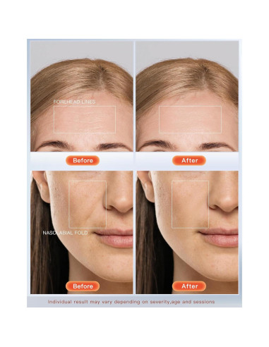 Máscara Facial LED NEWKEY Terapia Luz Roja y Azul 150 LEDs