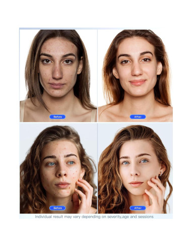 Máscara Facial LED NEWKEY Terapia Luz Roja y Azul 150 LEDs