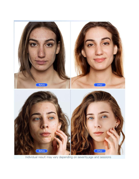 Máscara Facial LED NEWKEY Terapia Luz Roja y Azul 150 LEDs