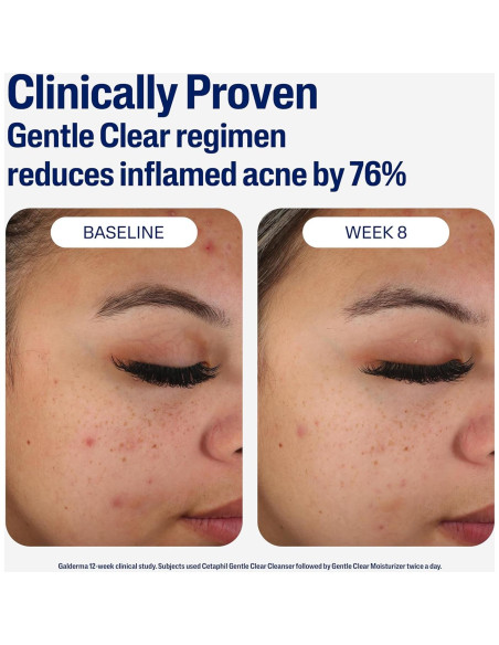 Hidratante Facial Cetaphil 85 g Matificante para Acné