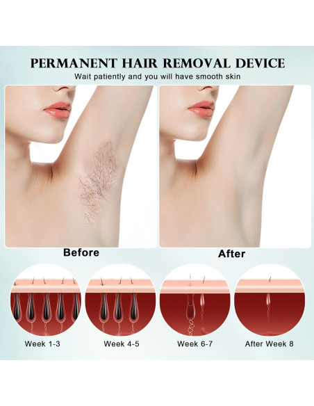 DEESS Removedor de Vello IPL GP590 con Enfriamiento Indoloro