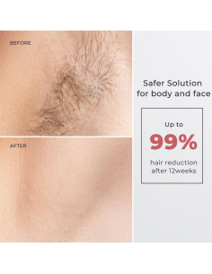 Depiladora Láser Aopvui IPL Enfriamiento por Hielo 999999 Destellos 2