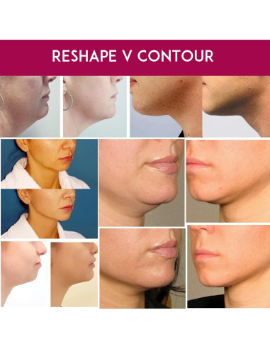 Mascarilla Facial ANACIS V-Line para Doble Barbilla y Cuello