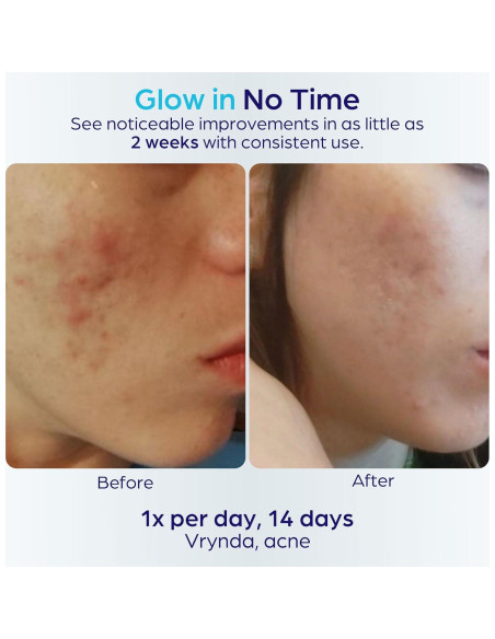 Máscara Facial LED Terapia de Luz Roja y Azul Ambicare PR7001US