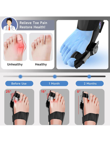 Corrector de Juanetes HUQKIYA Ajustable para Pies Izquierdo/Derecho