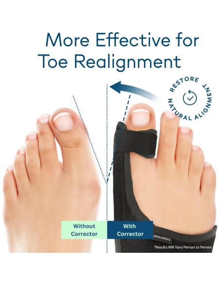 Corrector de Juanetes Caretras Unisex Ajustable 17.5x13.2cm