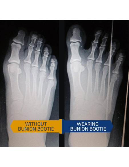 Corrector de Juanetes Bunion Bootie Pie Izquierdo Medio