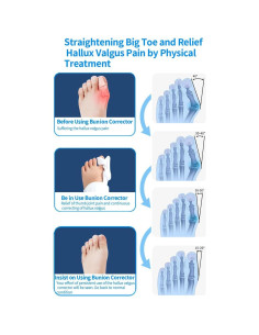 Corrector de Juanetes Hallux Valgus Ajustable Blanco 2