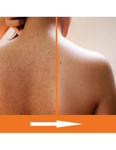 Jabón Corporal Exfoliante KERAPIL Ácido Salicílico 2 Pk