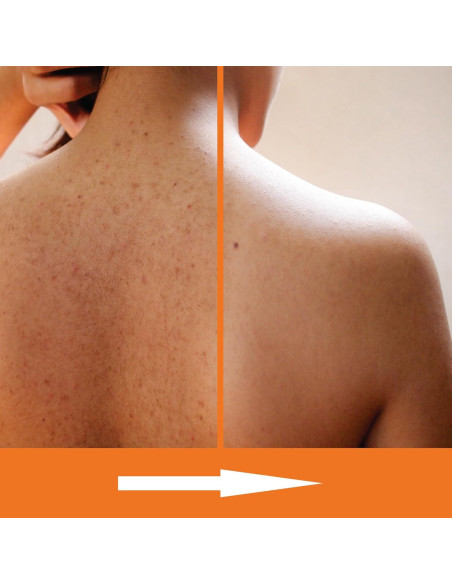 Jabón Corporal Exfoliante KERAPIL Ácido Salicílico 2 Pk