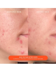 Crema y Gel Limpiador SOS Tower 28 para Piel Sensible 150ml 2