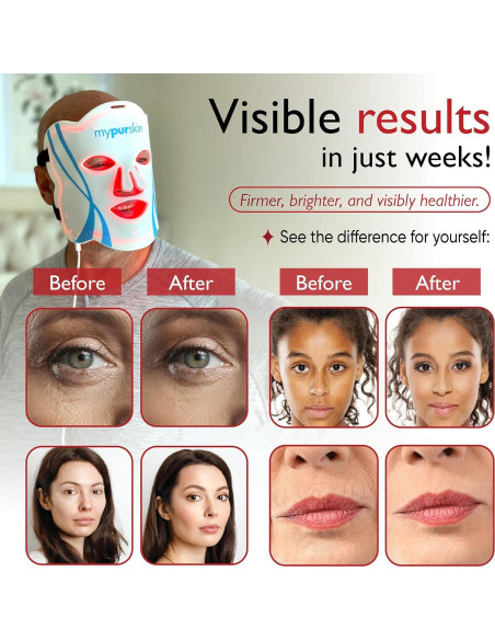 Máscara de Terapia de Luz LED Mypurskin, Aprobada por la FDA, 264 LED, 4 Longitudes de Onda para Arrugas y Acné