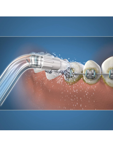 Consejos de Reemplazo Waterpik OD-100E para Brackets Dentales