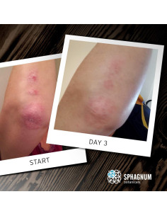 Jabón Corporal Natural Sphagnum 399.5 ml para Psoriasis y Eczema 2