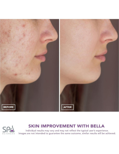 Extractor de Poros Spa Sciences BELLA 3-en-1 Microdermoabrasión