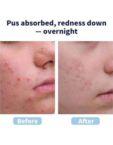 Parches para Espinillas Zeefpod XL - 264 Unidades, 9 Tamaños