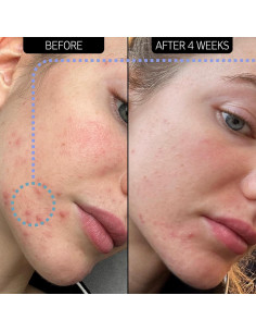 Hidratante The INKEY List Novoretin 2% 50 ml para Acné 2