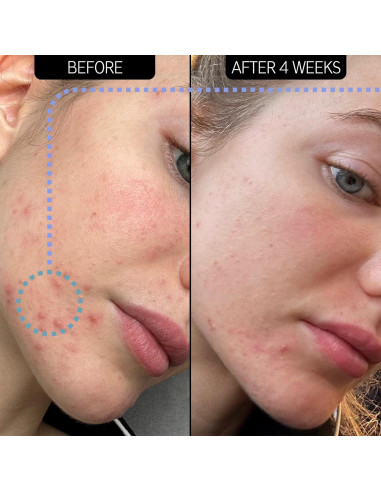 Hidratante The INKEY List Novoretin 2% 50 ml para Acné