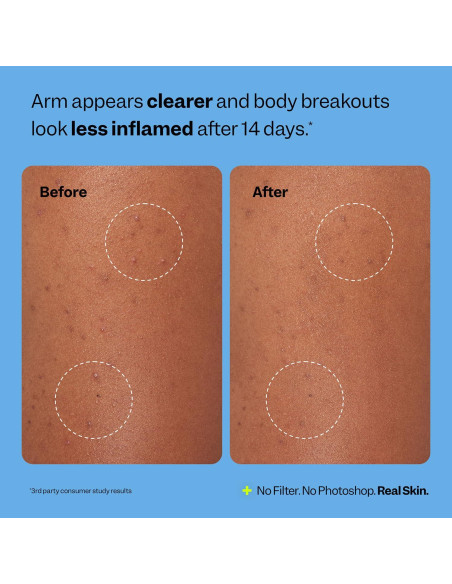 Parche Hidrocoloide para Brotes Corporales Peach Slices - 6 Unidades