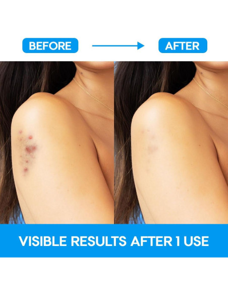 Parches para Granos Extra Grandes EZACNE - Hidrocoloide Médico 5 Unidades