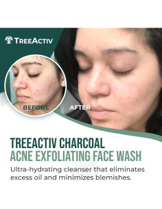 TreeActiv Lavado Facial de Carbón 96 ml - Exfoliante Acné 2