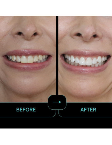 Prostrips - 12 Tonos Más Blancos - 56 Tiras Remineralizantes