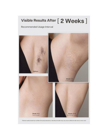 Dispositivo IPL LYRA para Eliminación de Vello - Enfriamiento Zafiro