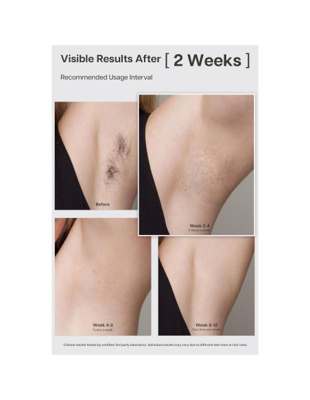 Dispositivo IPL LYRA para Eliminación de Vello - Enfriamiento Zafiro