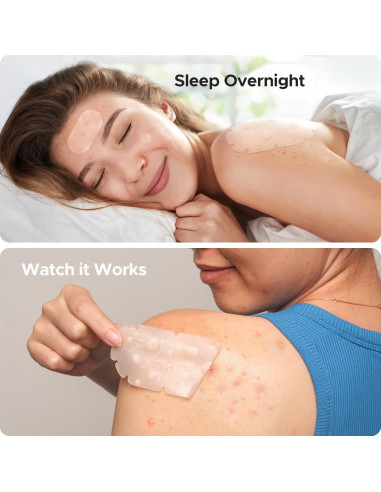 Parches para Acné Corporal TKTK XXL - 110 Piezas Hidrocoloide