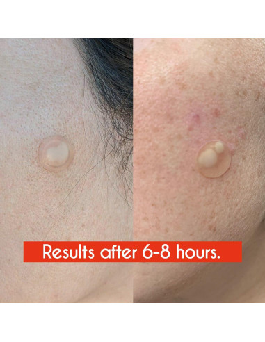 Parche Hidrocoloide para Granos ZHAOLIESM - 122 Conteos