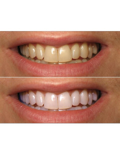 Gel Blanqueador Dental ProDental 10 Jeringas 35% Peróxido 2