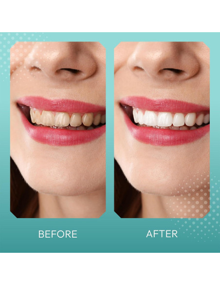 Tiras Blanqueadoras BrightTeal - 14 Tiras - Sin Peróxido