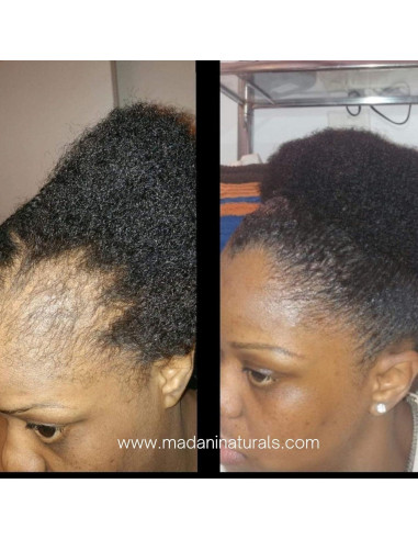 Aceite Estimulador del Crecimiento del Cabello Madani Naturals 59ml