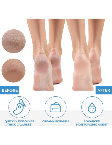 Removedor de Callos ForPro 32 oz. Fórmula Hidratante Rápida