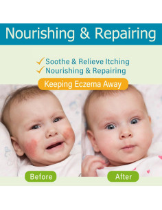 Crema para Eccema Infantil AOAO 100ml - Hipoalergénica y Nutritiva 2