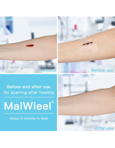 Cierre de Heridas Sin Puntos MaiWieel 2 Piezas 15x10cm 2