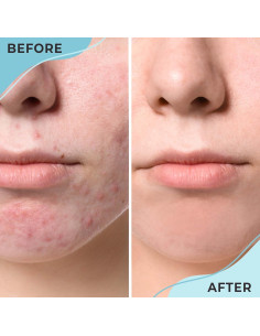 Crema Nocturna Ayadara para Acné Quístico Hormonal 120 Usos 2