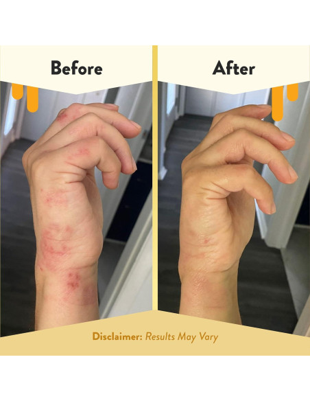 Aceite Corporal Antioxidante ECZEMA HONEY 236.6 ml - Hidratante Sin Fragancia para Piel Seca