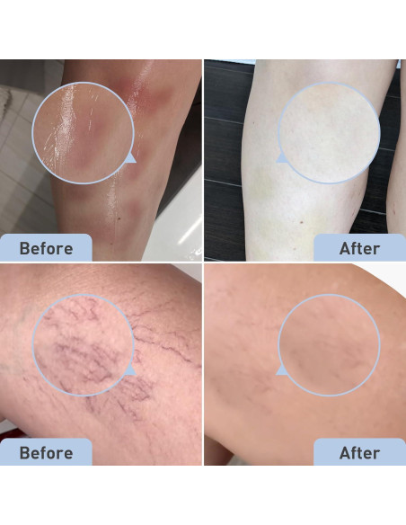 Gel Remedio PROcure para Moretones con Arnica 59 ml