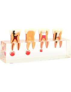 Modelo de Diente 4018 XINGXING Tratamiento Endodóntico 4 Etapas 2