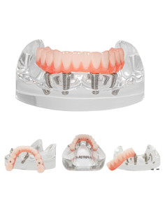 Modelo de Implante Dental Typodont Transparente All-on-4