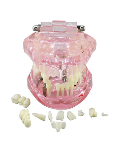 Modelo de Diente Typodont para Implantes Dentales 2001P