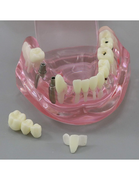 Modelo de Diente Typodont para Implantes Dentales 2001P