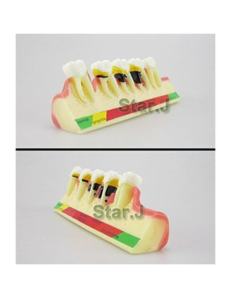 Modelo Typodont Dental Airgoesin para Enfermedad Periodontal