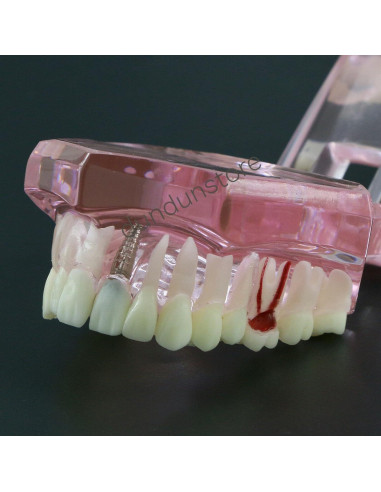 Modelo de Diente Typodont para Implantes Dentales 2001P