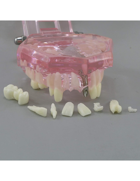 Modelo de Diente Typodont para Implantes Dentales 2001P