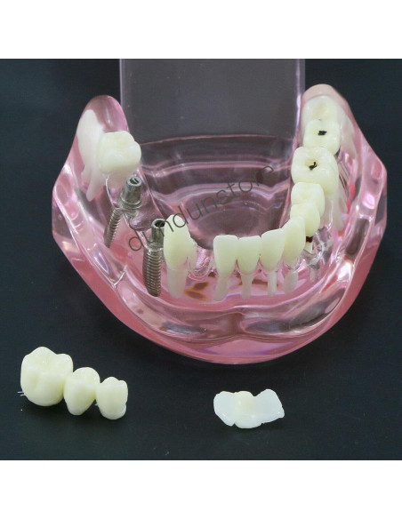 Modelo de Diente Typodont para Implantes Dentales 2001P