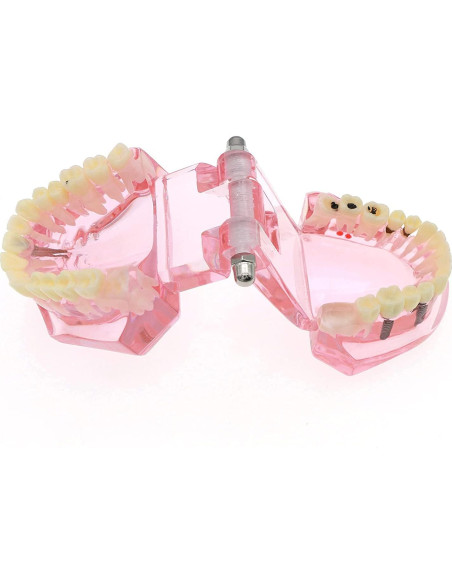 Modelo de Diente Typodont para Implantes Dentales 2001P