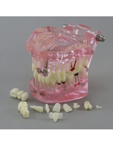 Modelo de Diente Typodont para Implantes Dentales 2001P