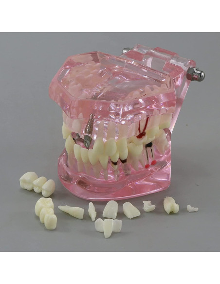 Modelo de Diente Typodont para Implantes Dentales 2001P